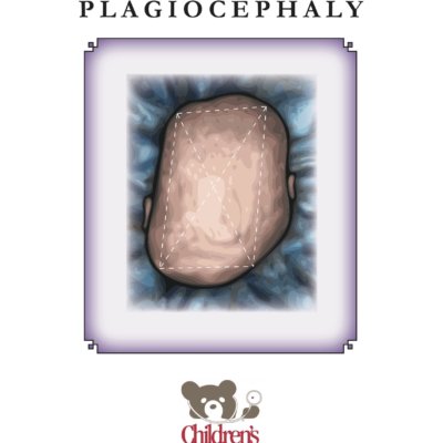 Plagiocephaly